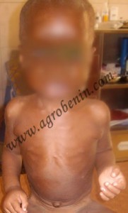 La malnutrition des enfants, un fait réel au Bénin